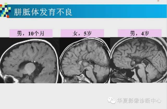 【PPT】胼胝体病变的MR诊断