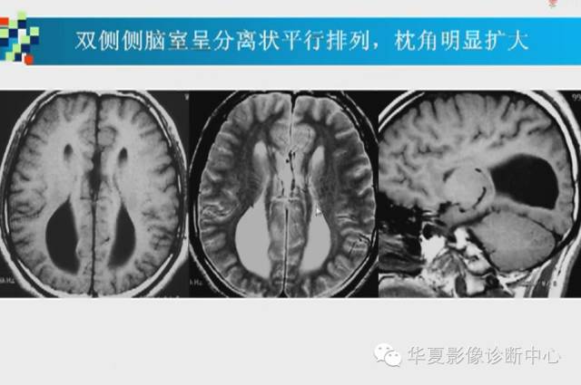 【PPT】胼胝体病变的MR诊断