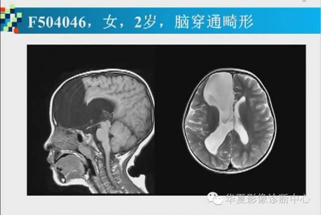 【PPT】胼胝体病变的MR诊断