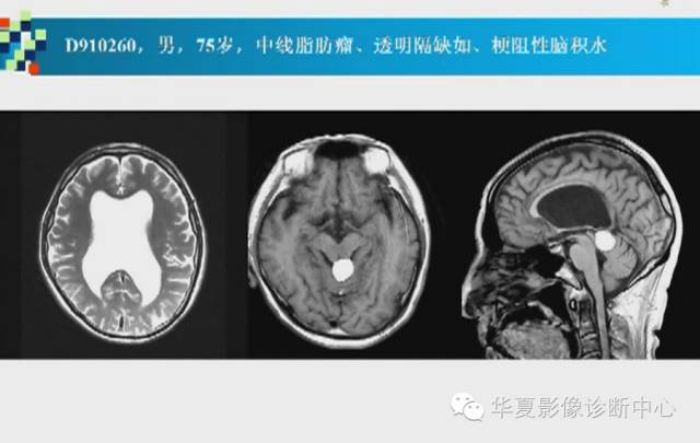 【PPT】胼胝体病变的MR诊断