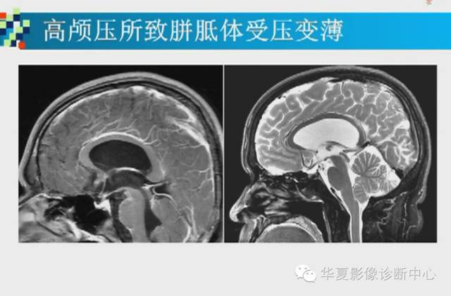 【PPT】胼胝体病变的MR诊断