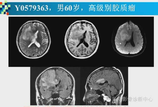 【PPT】胼胝体病变的MR诊断