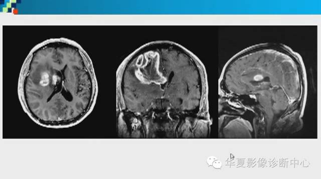 【PPT】胼胝体病变的MR诊断