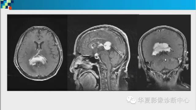 【PPT】胼胝体病变的MR诊断