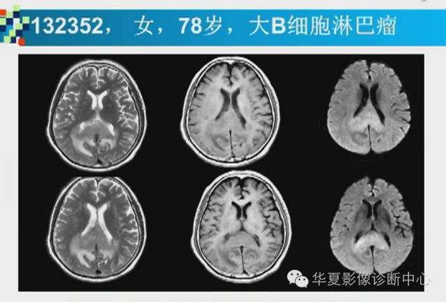 【PPT】胼胝体病变的MR诊断