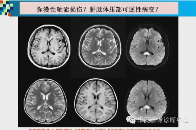【PPT】胼胝体病变的MR诊断