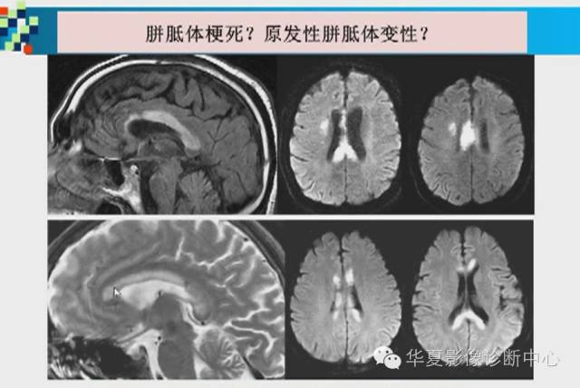 【PPT】胼胝体病变的MR诊断