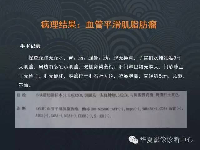 【病例】肝脏血管平滑肌脂肪瘤1例CT影像表现
