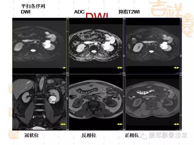 【PPT】肾囊实性病变分析 【PPT】肾囊实性病变分析
