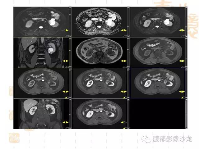 【PPT】肾囊实性病变分析 【PPT】肾囊实性病变分析