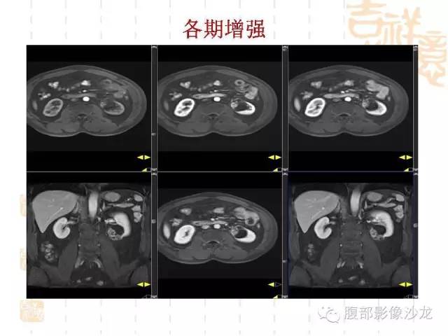 【PPT】肾囊实性病变分析 【PPT】肾囊实性病变分析