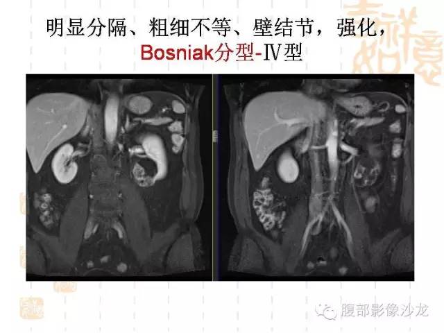 【PPT】肾囊实性病变分析 【PPT】肾囊实性病变分析