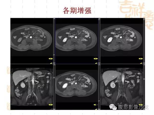【PPT】肾囊实性病变分析 【PPT】肾囊实性病变分析