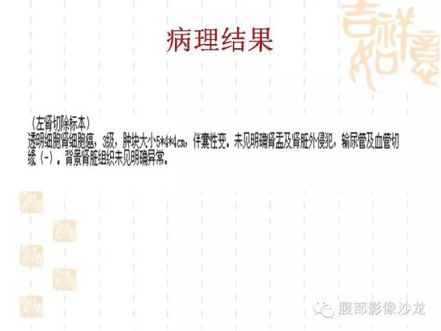 【PPT】肾囊实性病变分析 【PPT】肾囊实性病变分析