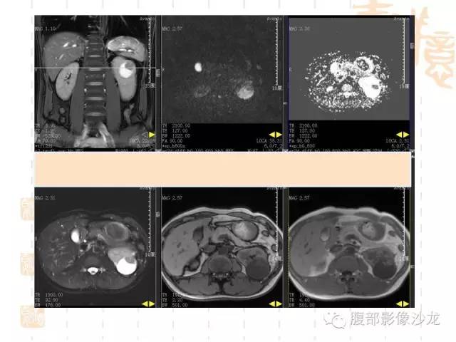 【PPT】肾囊实性病变分析 【PPT】肾囊实性病变分析