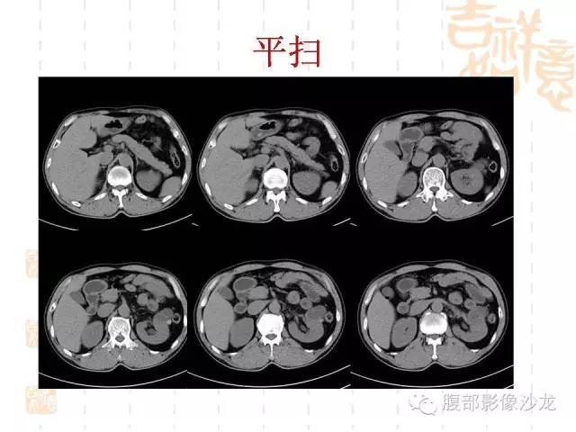 【PPT】肾囊实性病变分析 【PPT】肾囊实性病变分析