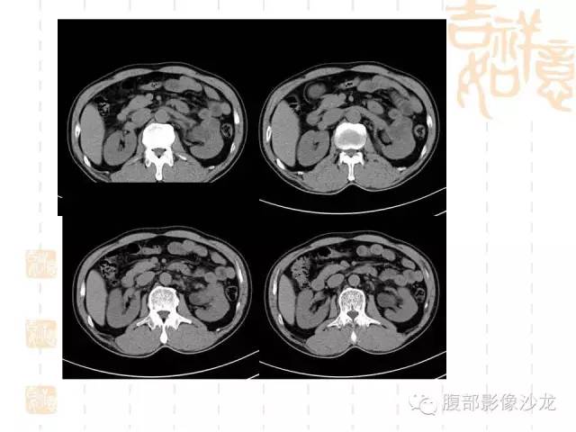 【PPT】肾囊实性病变分析 【PPT】肾囊实性病变分析