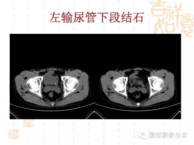 【PPT】肾囊实性病变分析 【PPT】肾囊实性病变分析
