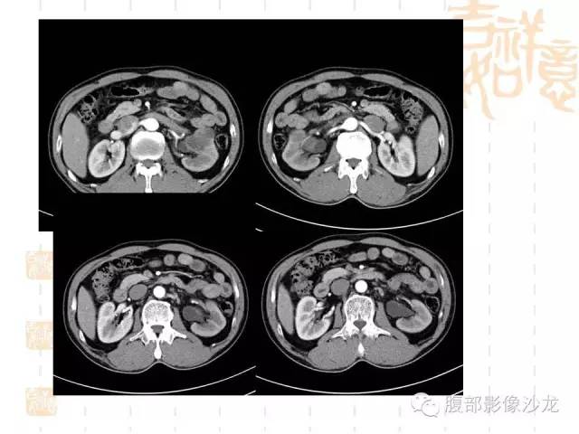 【PPT】肾囊实性病变分析 【PPT】肾囊实性病变分析