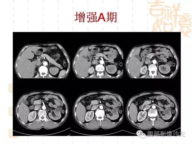 【PPT】肾囊实性病变分析 【PPT】肾囊实性病变分析