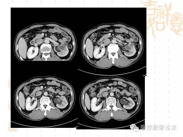 【PPT】肾囊实性病变分析 【PPT】肾囊实性病变分析