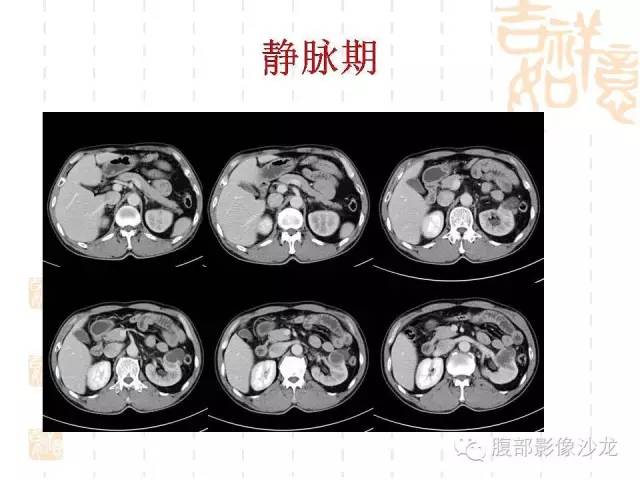 【PPT】肾囊实性病变分析 【PPT】肾囊实性病变分析