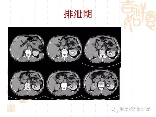 【PPT】肾囊实性病变分析 【PPT】肾囊实性病变分析