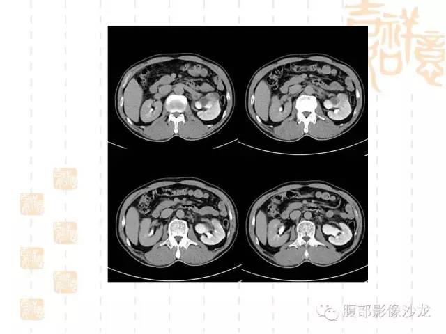 【PPT】肾囊实性病变分析 【PPT】肾囊实性病变分析