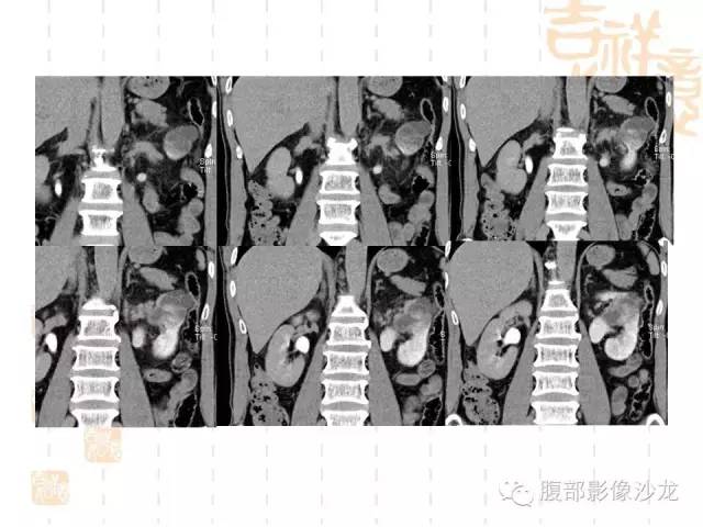 【PPT】肾囊实性病变分析 【PPT】肾囊实性病变分析