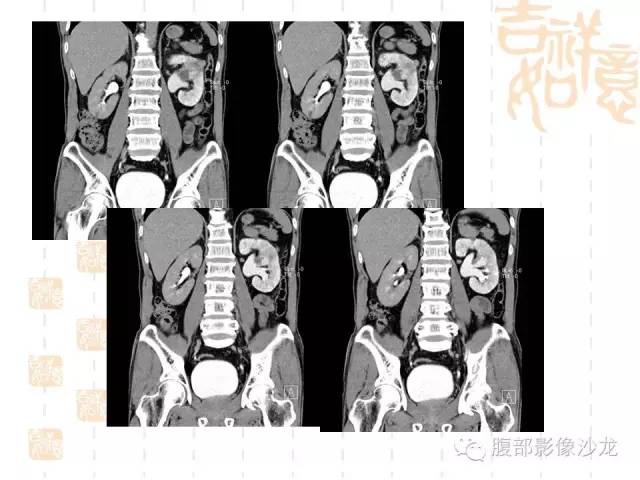 【PPT】肾囊实性病变分析 【PPT】肾囊实性病变分析