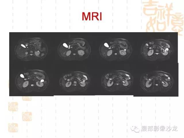 【PPT】肾囊实性病变分析 【PPT】肾囊实性病变分析