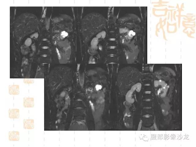 【PPT】肾囊实性病变分析 【PPT】肾囊实性病变分析