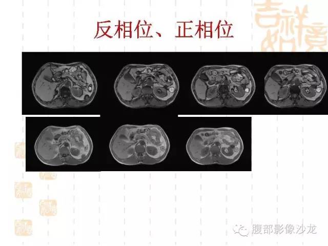 【PPT】肾囊实性病变分析 【PPT】肾囊实性病变分析
