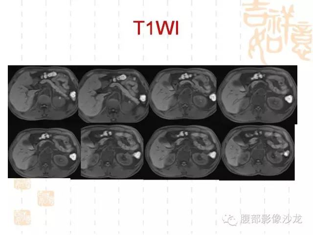 【PPT】肾囊实性病变分析 【PPT】肾囊实性病变分析