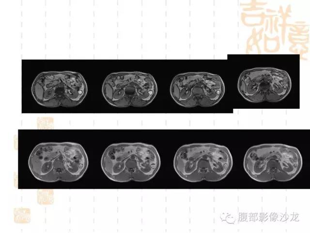 【PPT】肾囊实性病变分析 【PPT】肾囊实性病变分析