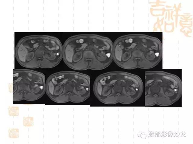 【PPT】肾囊实性病变分析 【PPT】肾囊实性病变分析