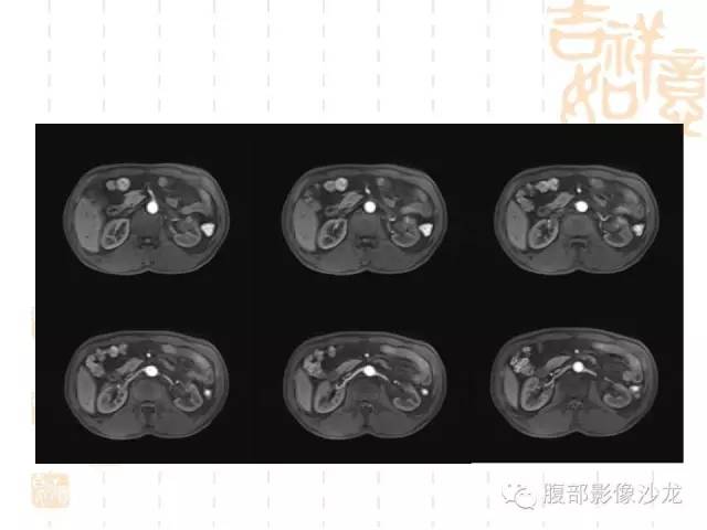 【PPT】肾囊实性病变分析 【PPT】肾囊实性病变分析