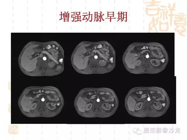 【PPT】肾囊实性病变分析 【PPT】肾囊实性病变分析
