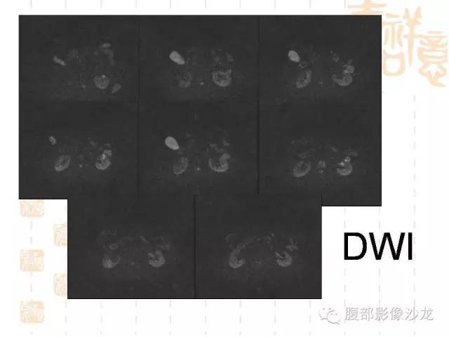 【PPT】肾囊实性病变分析 【PPT】肾囊实性病变分析