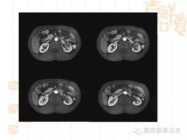 【PPT】肾囊实性病变分析 【PPT】肾囊实性病变分析