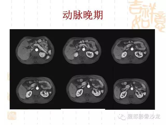 【PPT】肾囊实性病变分析 【PPT】肾囊实性病变分析