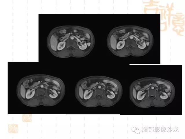 【PPT】肾囊实性病变分析 【PPT】肾囊实性病变分析