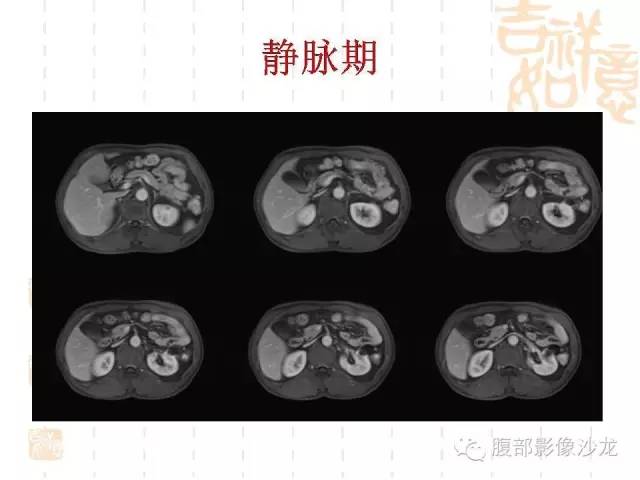 【PPT】肾囊实性病变分析 【PPT】肾囊实性病变分析