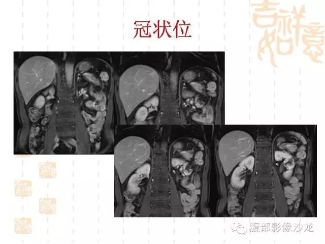 【PPT】肾囊实性病变分析 【PPT】肾囊实性病变分析