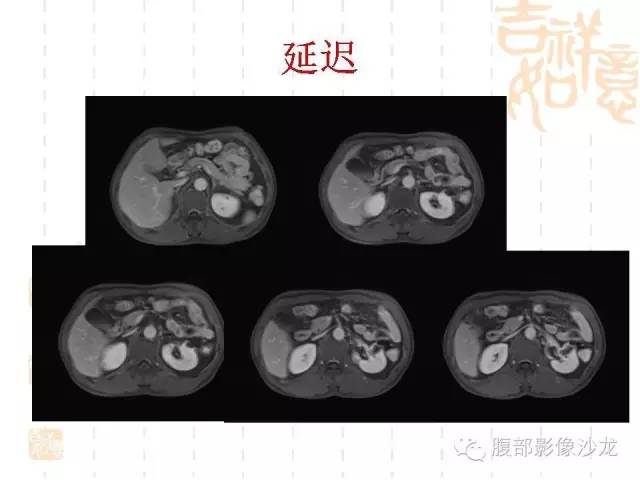 【PPT】肾囊实性病变分析 【PPT】肾囊实性病变分析