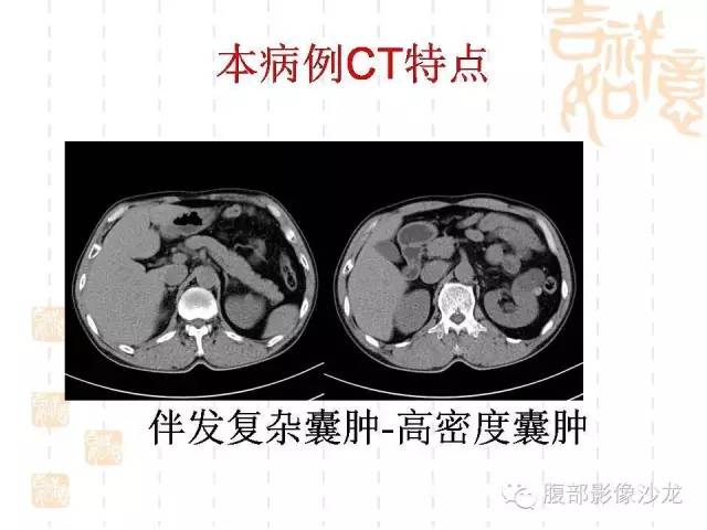 【PPT】肾囊实性病变分析 【PPT】肾囊实性病变分析