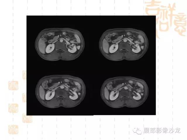 【PPT】肾囊实性病变分析 【PPT】肾囊实性病变分析
