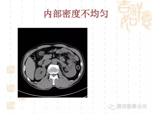 【PPT】肾囊实性病变分析 【PPT】肾囊实性病变分析