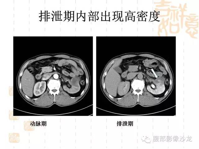 【PPT】肾囊实性病变分析 【PPT】肾囊实性病变分析