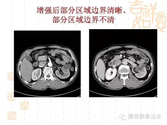 【PPT】肾囊实性病变分析 【PPT】肾囊实性病变分析